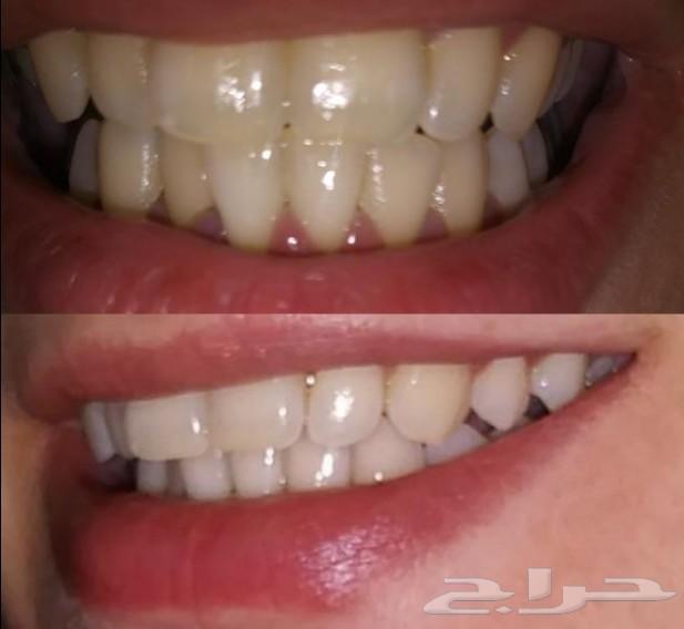 اخر كمية من مسحوق تبييض الاسنان التوصيل مجاني