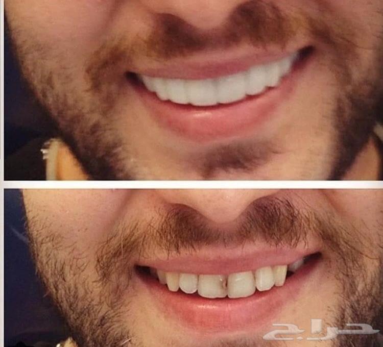 فينير اجمل اروع ابتسامة