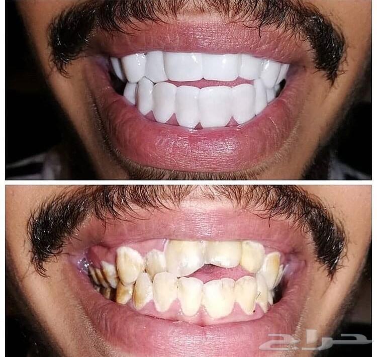 فينير اجمل اروع ابتسامة