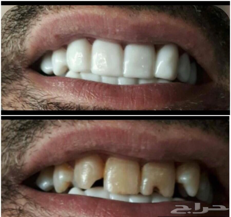 فينير اجمل اروع ابتسامة